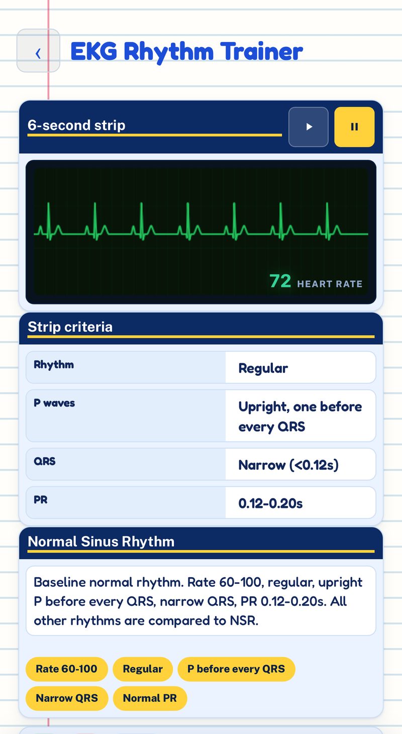 PYT app EKG Rhythm Trainer: live 6-second strip at 72 bpm with strip criteria for Normal Sinus Rhythm